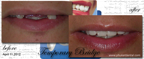 Temporary Crowns&Bridges at Phuket Dental Clinic,Thailand